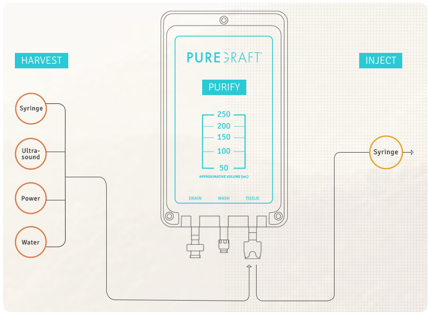 PureGraft 50 PURE-INT System VE 5