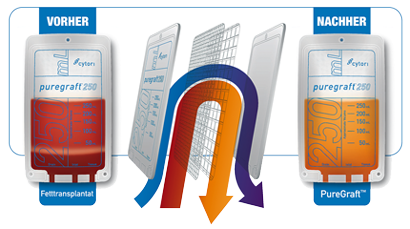 PureGraft 50 PURE-INT System VE 5