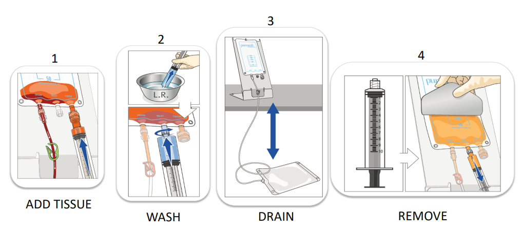 PureGraft 50 PURE-INT System 1 VE